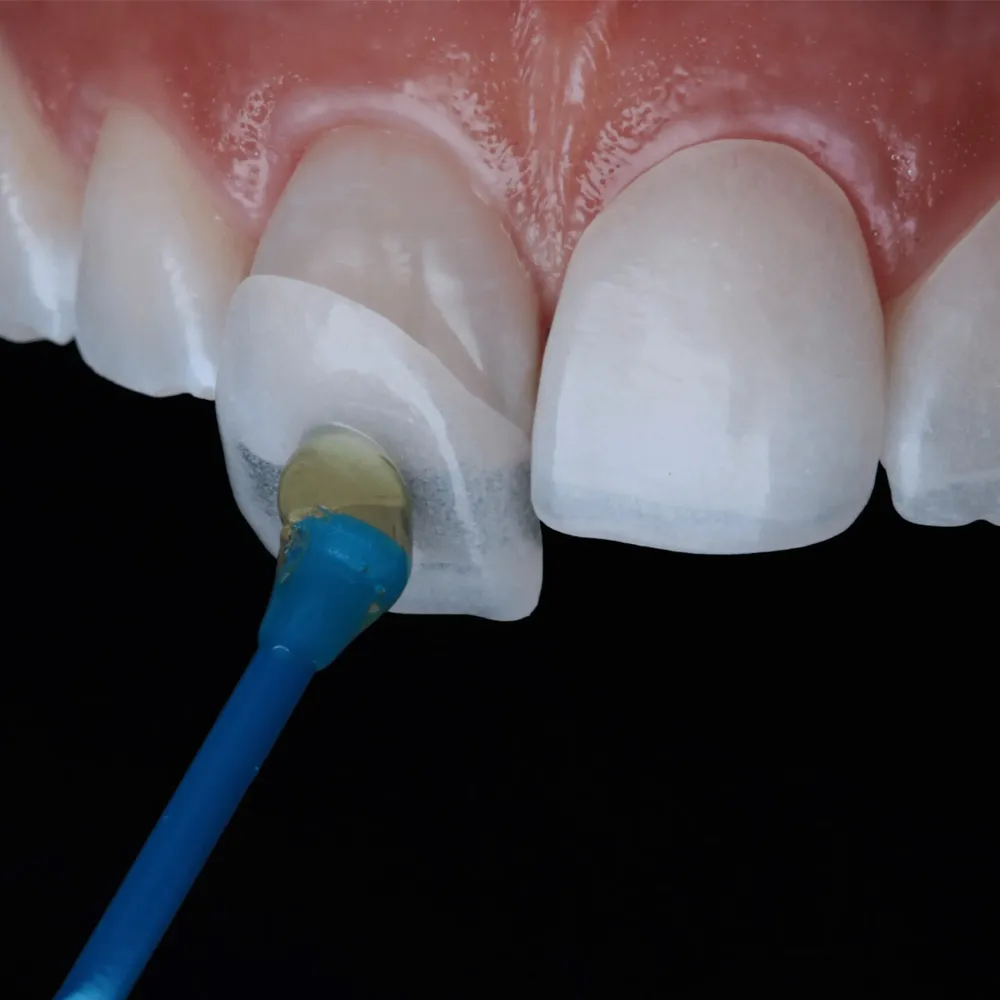 veneers