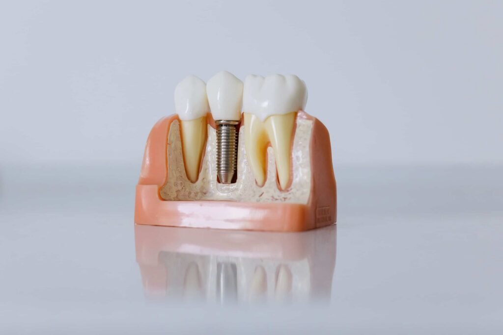 cover image of a blog about types of dental implants showcases an image of a dental impants model