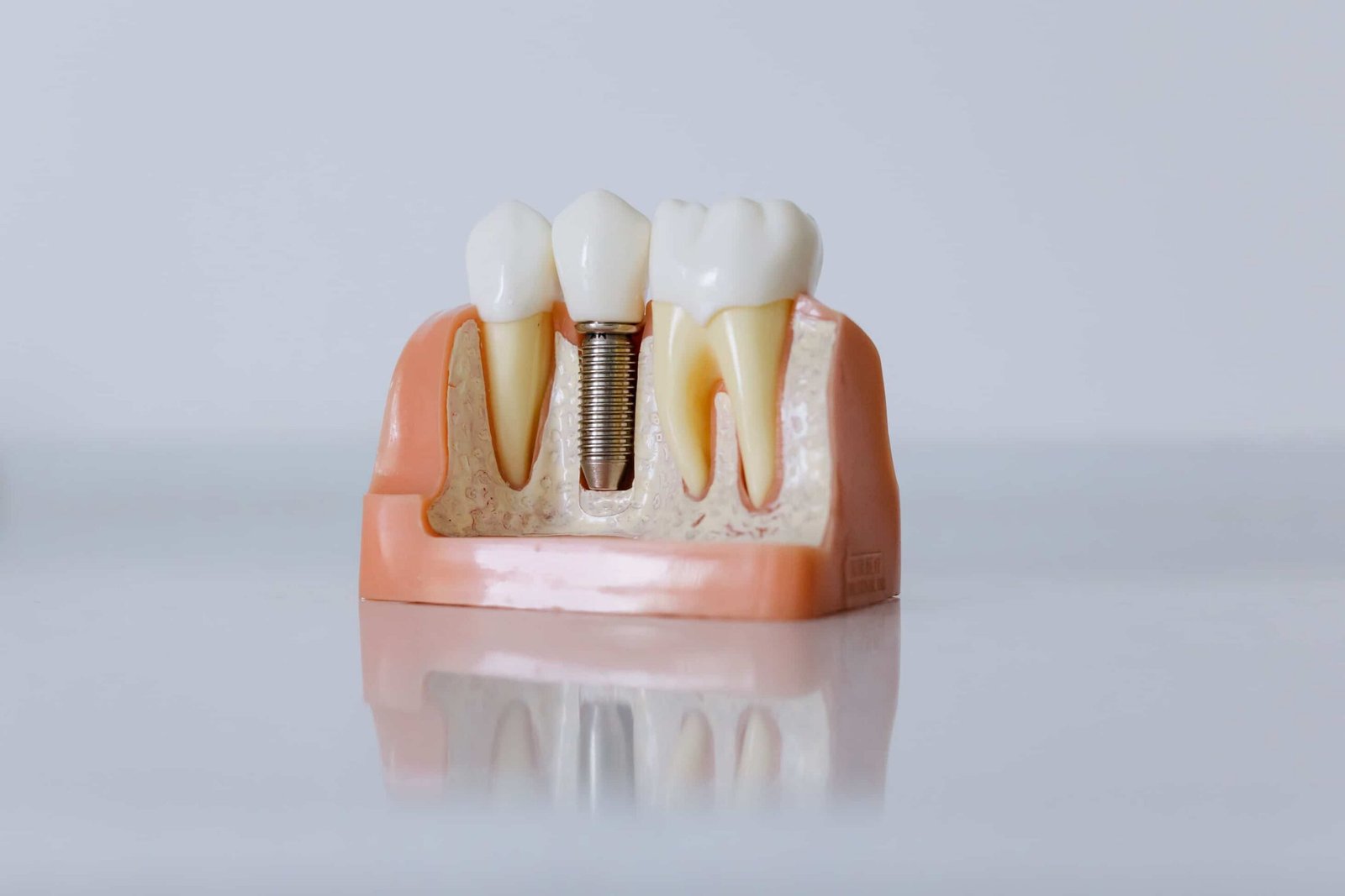cover image of a blog about types of dental implants showcases an image of a dental impants model